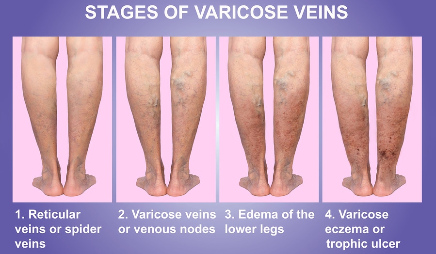 varicose veins surprise mesa AZ